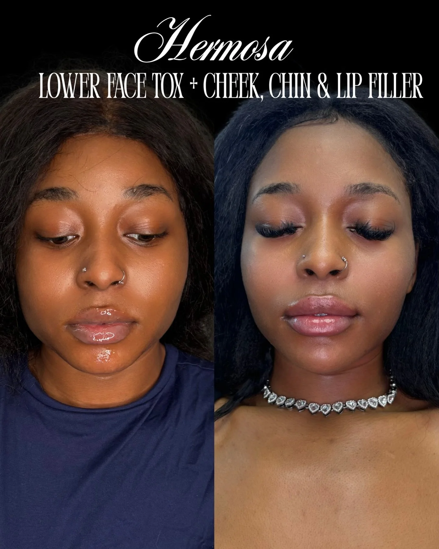 FILLER AND TOX DUO TRANSFORMATION✨🤍⭐️
@injectormyly 

💉 Neurotoxins to massetter over a month ago for facial slimming
💉 Chin filler over 2 sessions for lower face length and projection
💉 Lip filler over 2 sessions for improved volume and ratio
💉