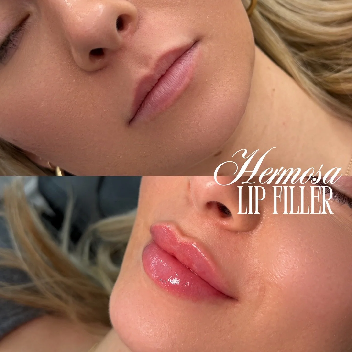 CLEAN GIRL LIPS, NATURAL + PLUMP+ SHAPE 💛⭐️

$315 HALF SYRINGE LIPS PROMO WITH @injectortifff 

Booking with Nurse tiff available online 💌