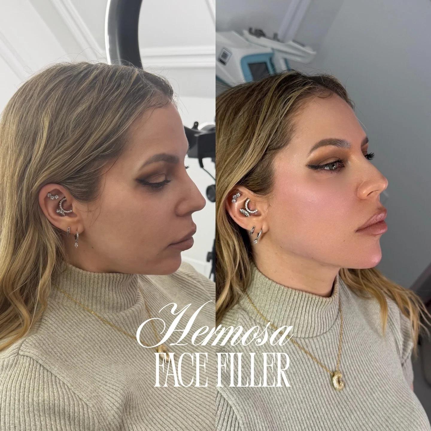 CHEEK AND CHIN FACIAL BALANCING ⭐️✨

FILLER PACKAGES AVAILABLE ONLINE 🤍

Booking available online for all locations 💌✨