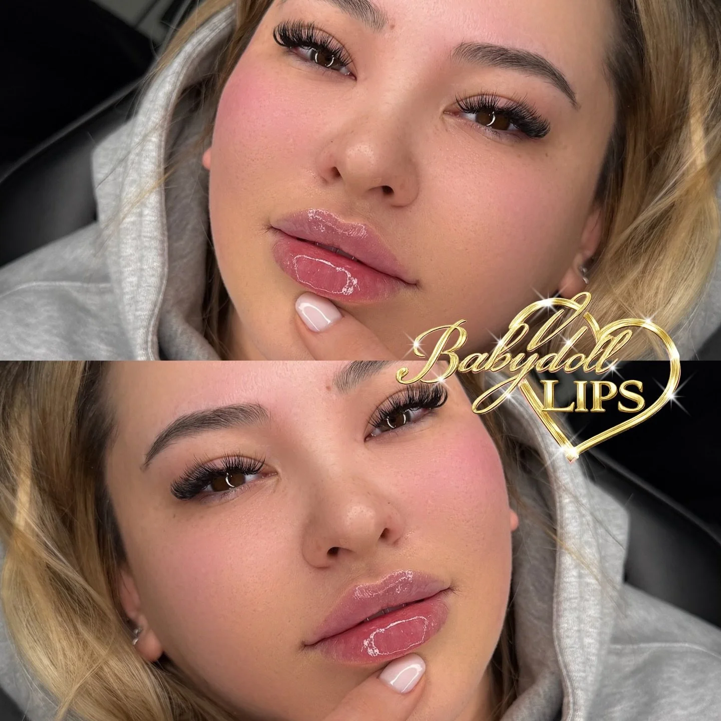 BABYDOLL LIPS HAVE OFFICIALLY ARRIVED AT HERMOSA🎀

We&rsquo;re now offering Babydoll lips, a 1 ml lip filler service performed using the famous Russian Lip Technique. Babydoll lips are designed to create a lifted, structured, doll-like shape✨

This 