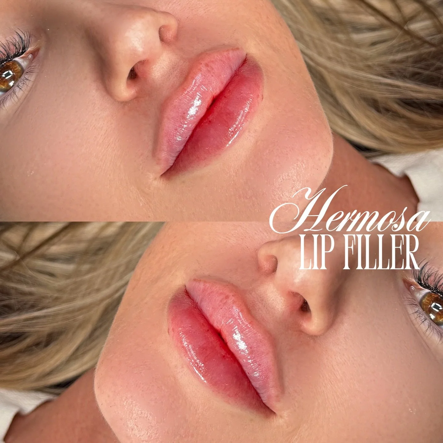 💗🎀 BARBIE LIPS 🎀💗

$300 HALF SYRINGE PROMO 🫶🏼

BOOKING WITH NURSE JOJO AVAILABLE ONLINE💌