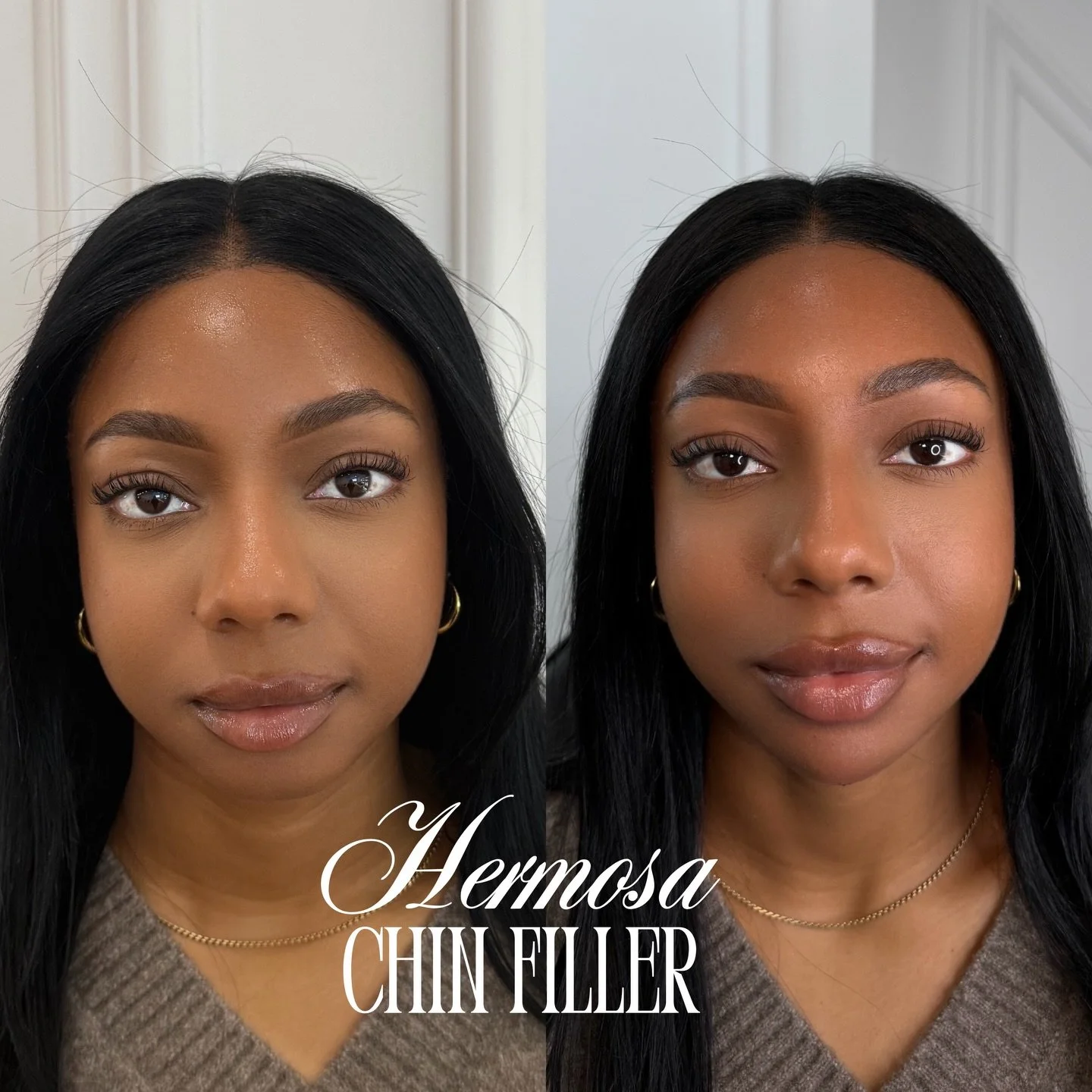 CHIN FILLER TRANSFORMATION USING &ldquo;SHAPE&rdquo; BY @revanesse ⭐️

Clients first session doing Chin filler. She will require multiple sessions to build out her projection to be more balanced with her facial silhouette 👀

Booking with @injectorti
