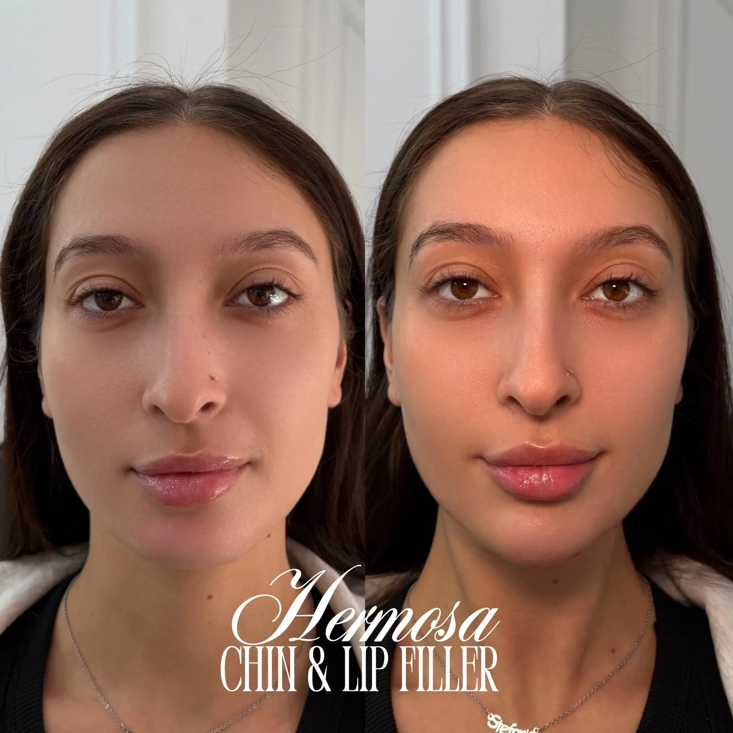 ADDING PROJECTION ON HER CHIN &amp; A LIP PLUMP TO CREATE A MORE HARMONIOUS FACIAL BALANCE ⭐️💛 

Chin filler is best built in multiple sessions to target projection, symmetry, point &amp; chin shadowing. 

Product 👀 @revanesse 

BOOKING WITH @injec