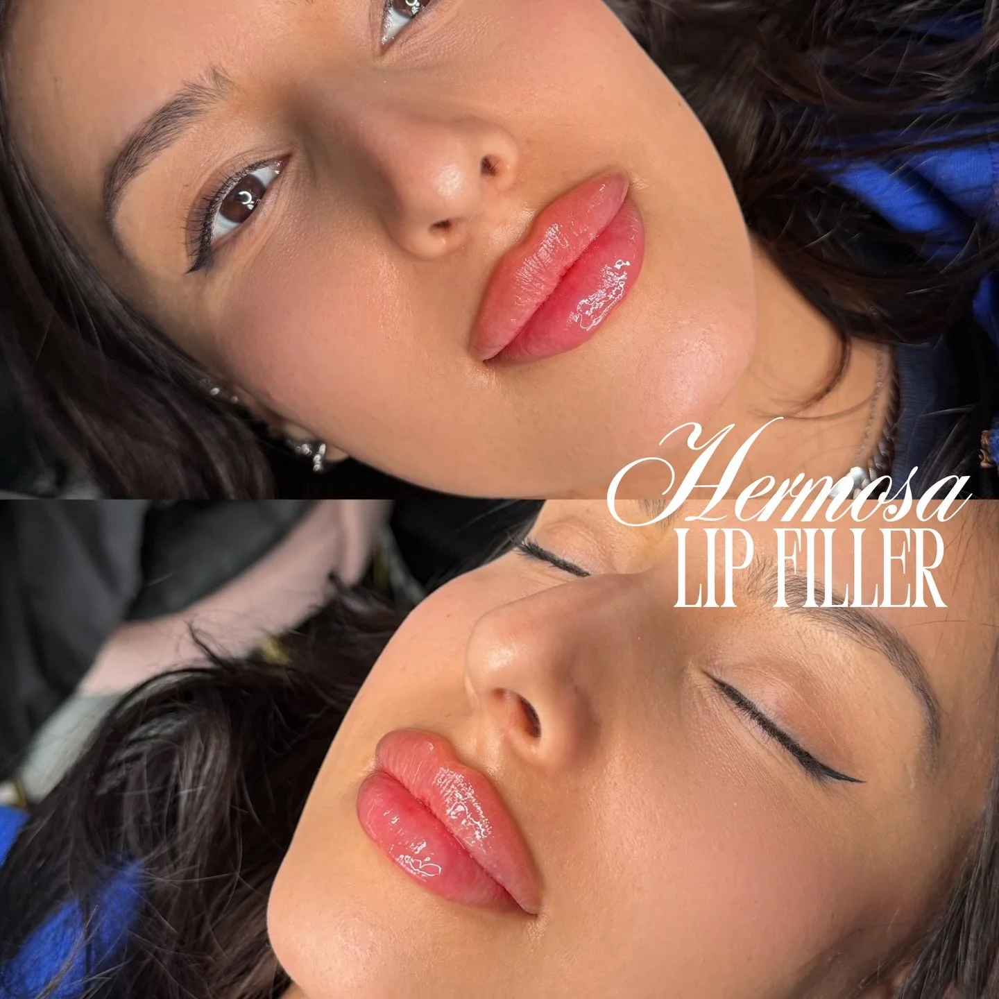 BADDIE CONTOUR LIPS USING THE ONE &amp; ONLY HERMOSA TECHNIQUE 💅🏼💗

Product @revanesse ⭐️⭐️⭐️⭐️⭐️

Booking with @injectorsof available online ay the king location exclusively 💗