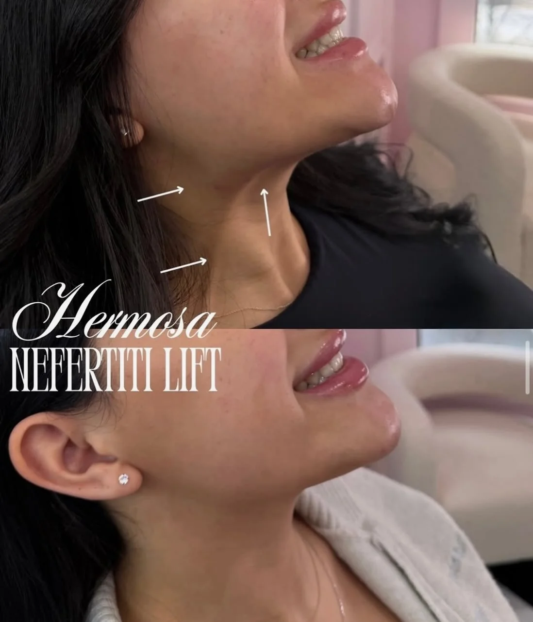 The Nefertiti Lift✨

Throwback to one of our favourite treatments with @injectortifff 🤍

This is a subtle yet powerful treatment where Botox is strategically placed along the platysma to relax the downward pole of the muscle. 

The results? Jawline 