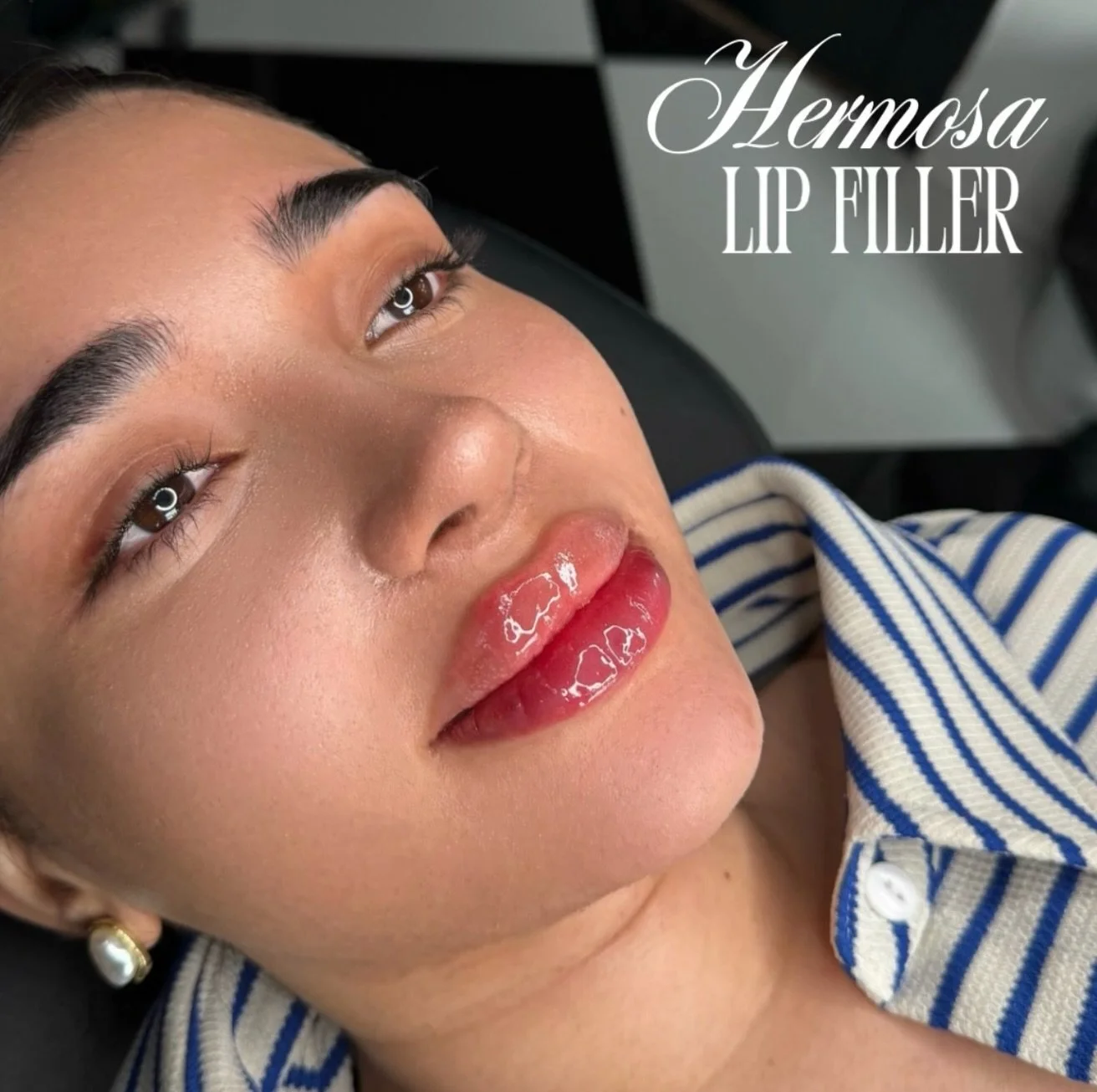 Birthday prep but make it HERMOSA
Soft, juicy, perfect 💋✨

Booking with @injectorsof available online ✨

BOOK THROUGH LINK IN BIO
$285 HALF SYRINGE LIP FILLER
$399 SKIN BOOSTER
$7 UNIT DYSPORT

#lip #lipbalm #lipfillers #nurse #fy