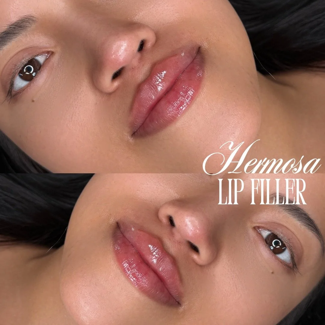 Latina lips 💃🏽🔥
Labios de latina&hellip; suaves, hidratados y perfectos 💉

Agenda tu cita ya con @injectorsof ✨

Reserva en el link de la bio
$285 MEDIO JERINGA DE RELLENO LABIAL
$399 SKIN BOOSTER
$7 POR UNIDAD DE DYSPORT

S&iacute;gueme para ver