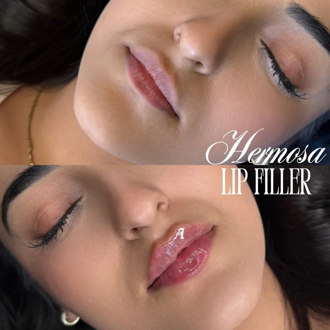 Luxury lips only 💎💋
Subtle volume, smooth finish, real confidence ✨

Booking with @injectorsof available online 

Limited spots available this week ⏳
$285 half syringe | $399 skin booster | $7/unit Dysport

#lip #lipfillers #nurse #fy