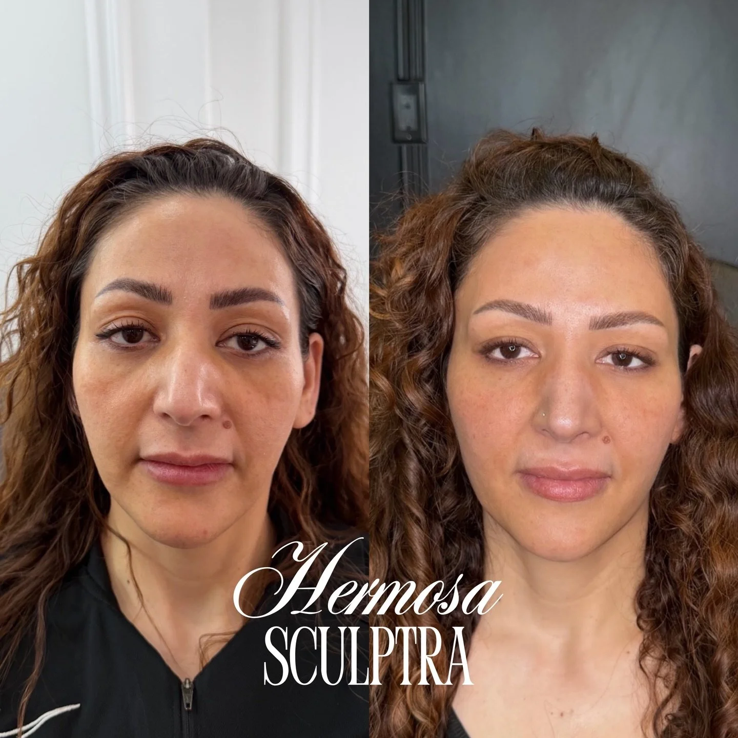 SCUPLTRA RESULTS AFTER TWO SESSIONS 😍⭐️💛

Before &rarr; 12 weeks after ✨
Results with Sculptra are gradual and regenerative, not instant.

This treatment works by stimulating your body&rsquo;s own collagen production, improving:
&bull; skin thickne