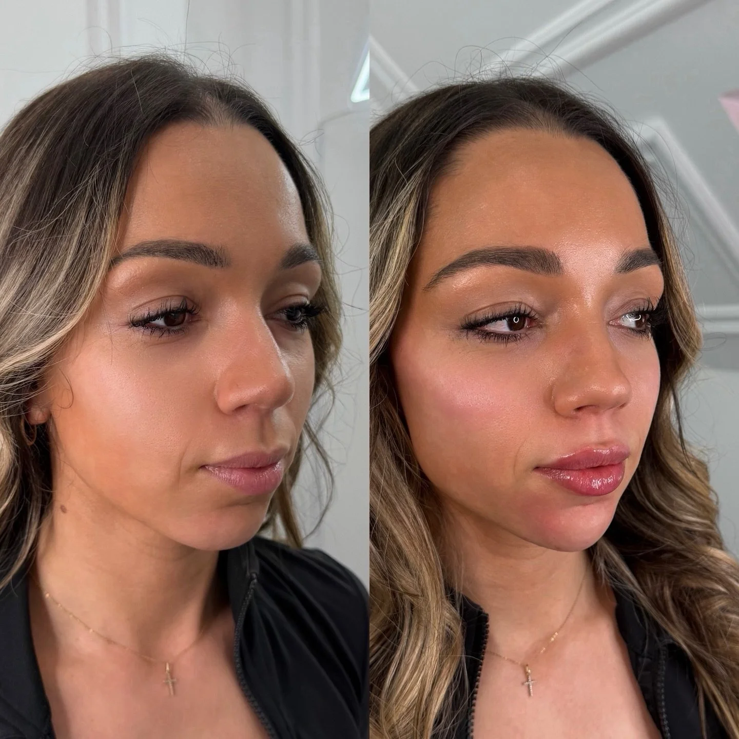 FACE FILLER TRANSFORMATION 💛⭐️

cheeks, lips, chin projection &amp; chin shawdowing.

BOOKING FOR FACE FILLER AVAILABLE ONLINE