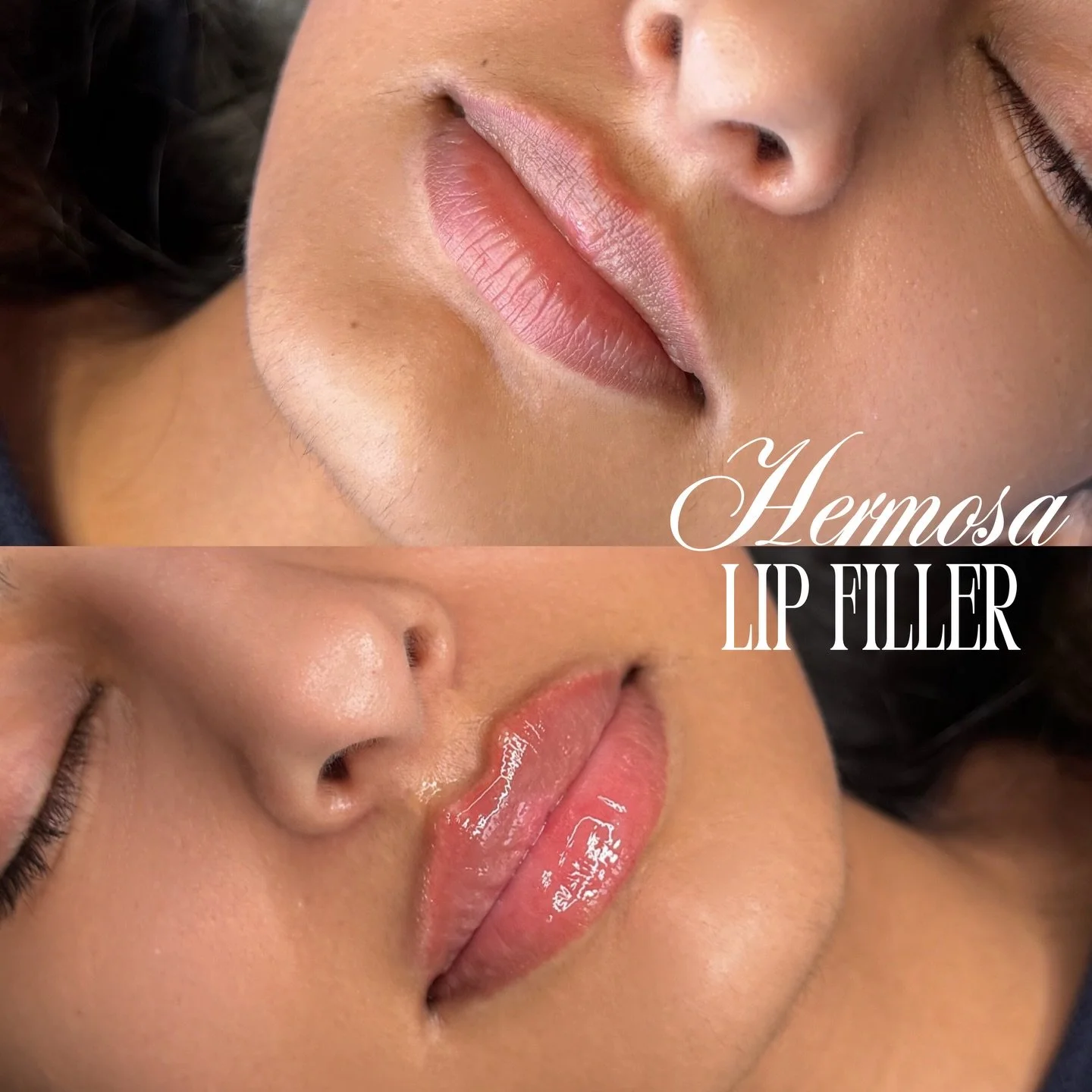 LIP-MAXING 👀⭐️💛

May Promo half syringe with Nurse Sofia $280 until the end of the month ⭐️

BOOKING WITH @injectorsof AVAILABLE ONLINE💌
