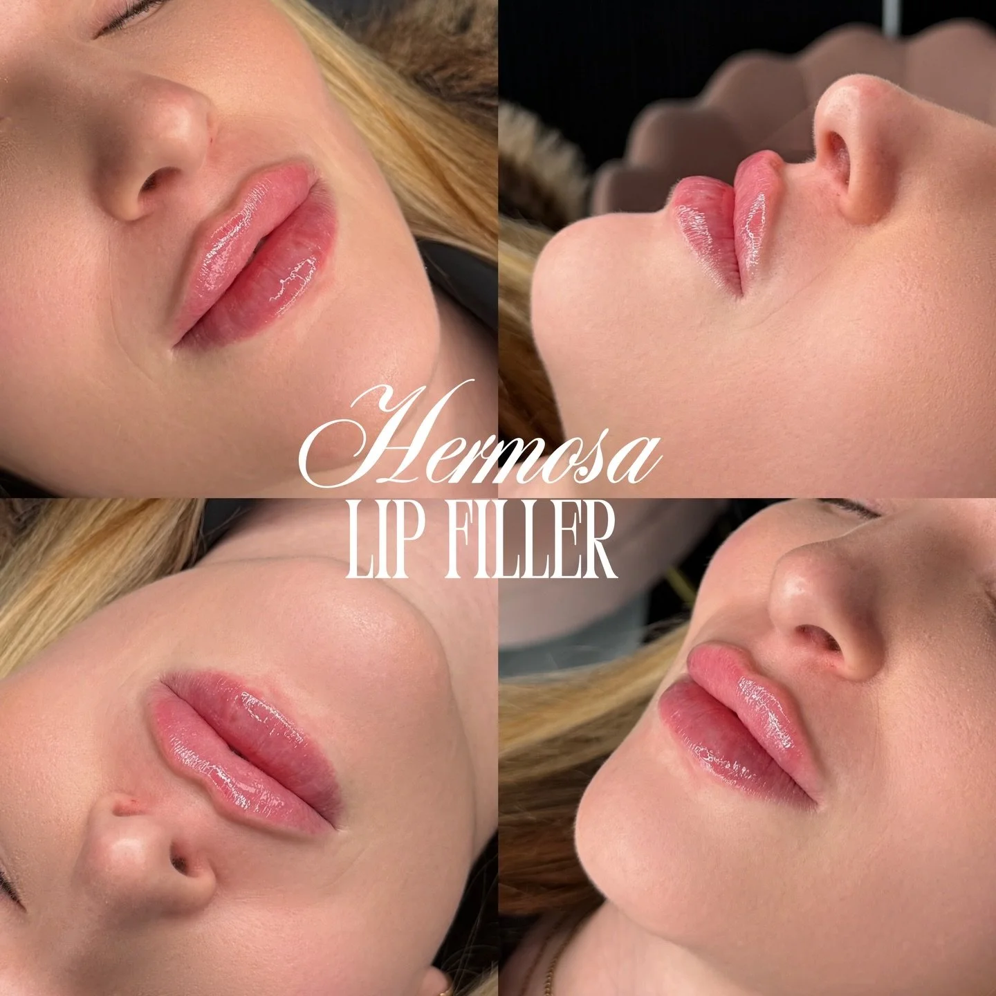 Lips ready for euro summer ☀️

May Promo half syringe with Nurse Sofia $280 until the end of the month✨ 

Early Tuesday appointments and Late Wednesday appointments available now ⚠️⚠️⚠️

BOOKING WITH @injectorsof AVAILABLE ONLINE 💌