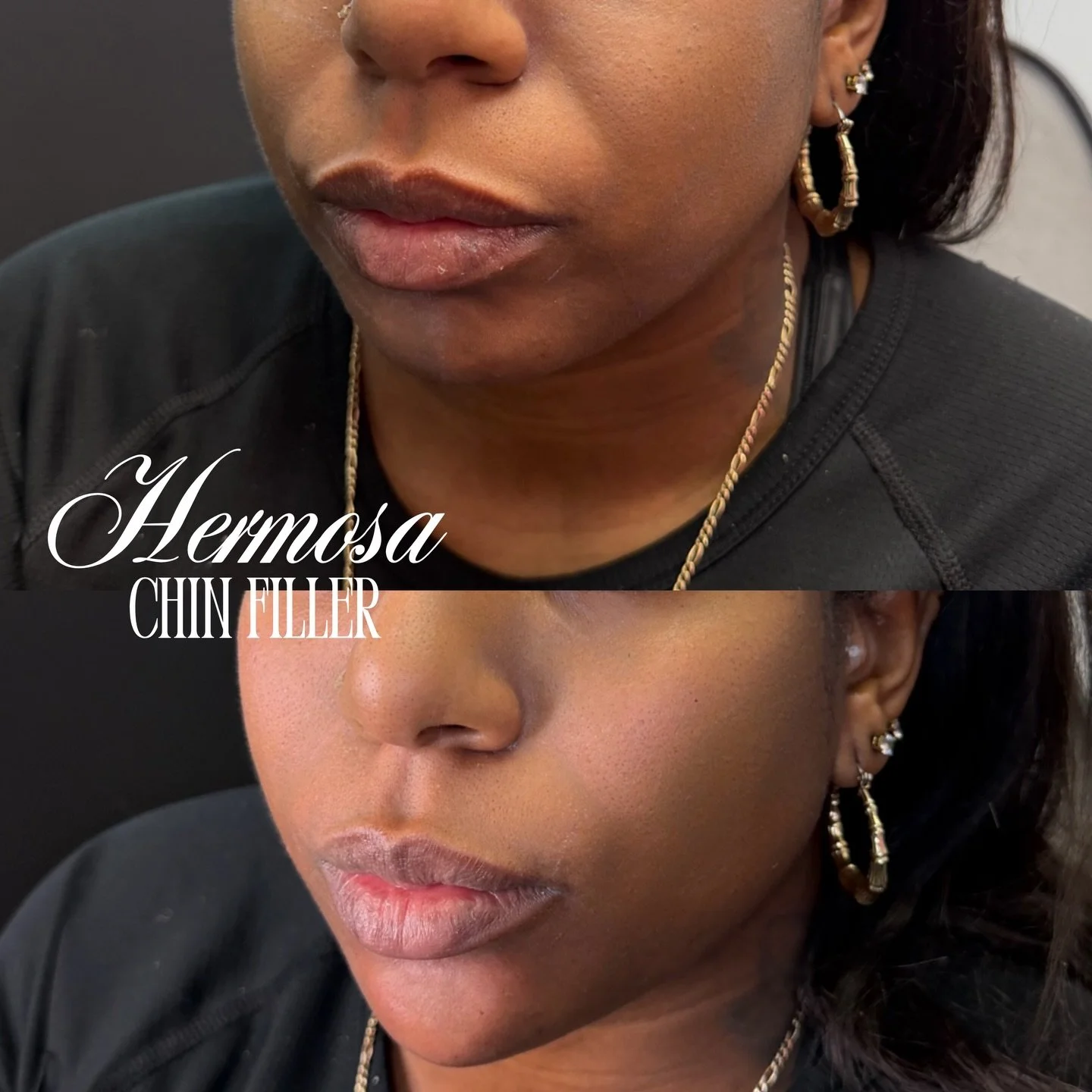 CHIN FILLER GALORE✨⭐️👀
@injectormyly 💛

Chin filler transformations are our favourite ✨ 

BOOKING WITH MYLY AVAILABLE ONLINE💌