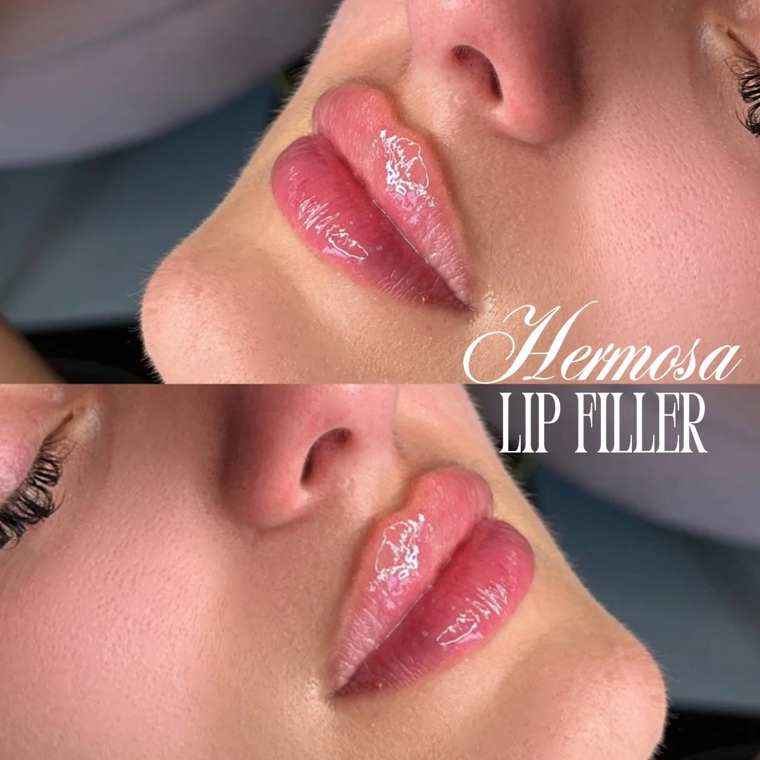 ✨ Perfectly plump. Effortlessly beautiful 😍

Booking with @injectorsof available online 💌 Exclusively at our King city location 📍

BOOK FOR JUNE PROMOS 🎀🎀🎀
$285 HALF SYRINGE LIP FILLER
$7/UNIT BOTOX
$399 SKIN BOOSTER

#latina #fy #gta #lipfille
