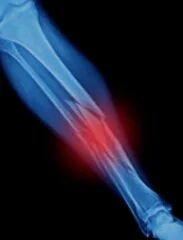 tibia.2.jpg