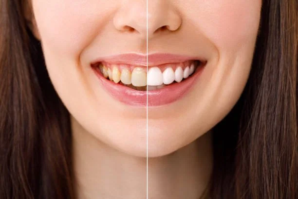 Teeth Whitening in Marin - Vohra DDS