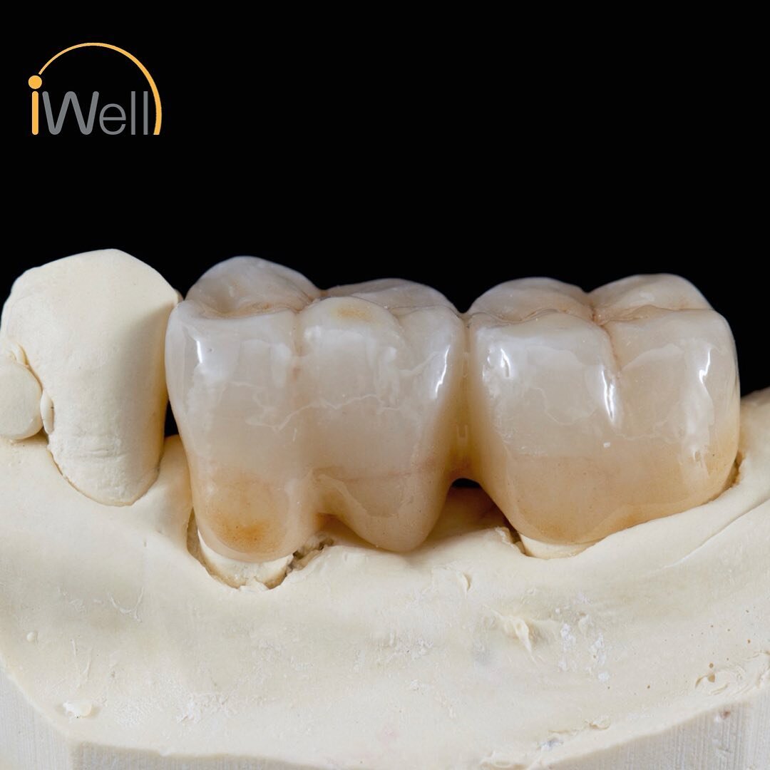 #iwellcadcam, #cadcamdentistry, #zirconia, #allceramics, #pfz, #dentallab, #prosthodontics, #estheticdentistry

iWell Porcelain Fused to Zirconia Bridge. 

When the patient&rsquo;s teeth color is difficult to match, we recommend using PFZ over fulll-