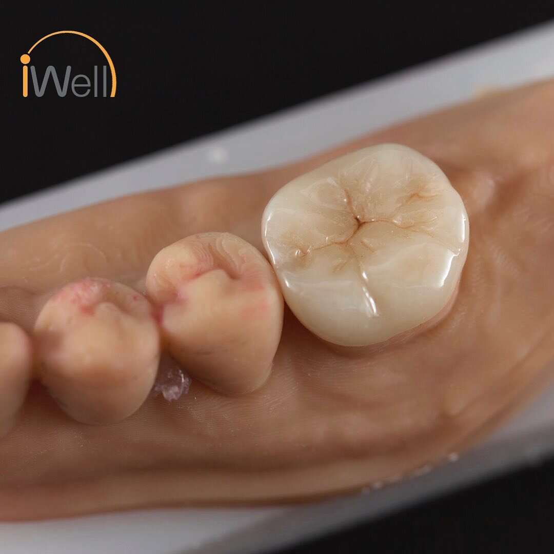 #emaxpress, #endocrown, #adhesivedentistry, #3dprinting, #itero, #allceramics 

This case was scanned with iTero intraoral scanner and models were 3D printed before waxing up the endo crown for pressing with eMax (Monolithic with Custom Staining)