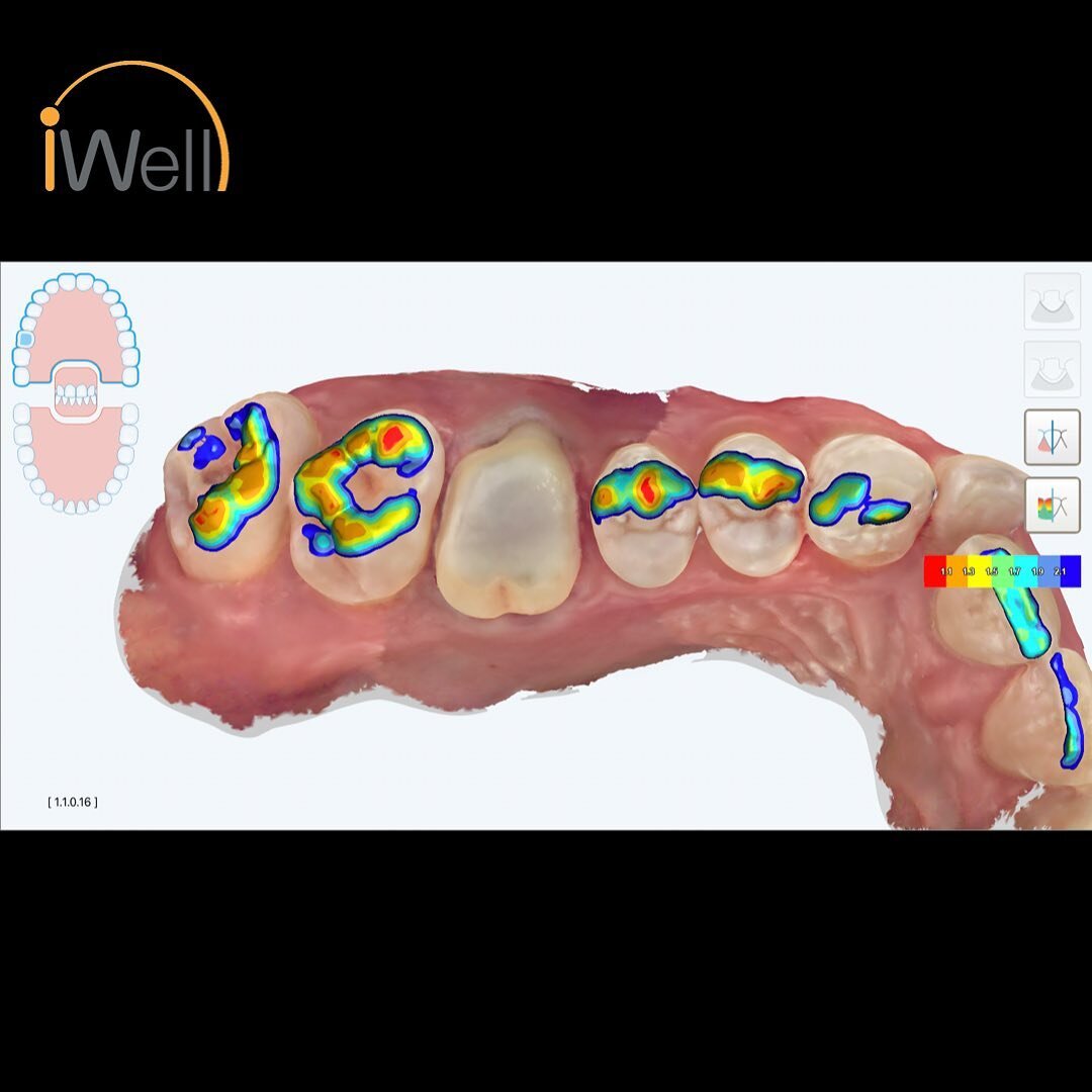 #overlay, #allceramics, #itero, #cadcamdentistry, #hkdentistry, #emaxpress, #prosthodontics, #adhesivedentistry, #prepdesign

Keeping supragingival margins allow for easy scanning and clear margins for our technicians.