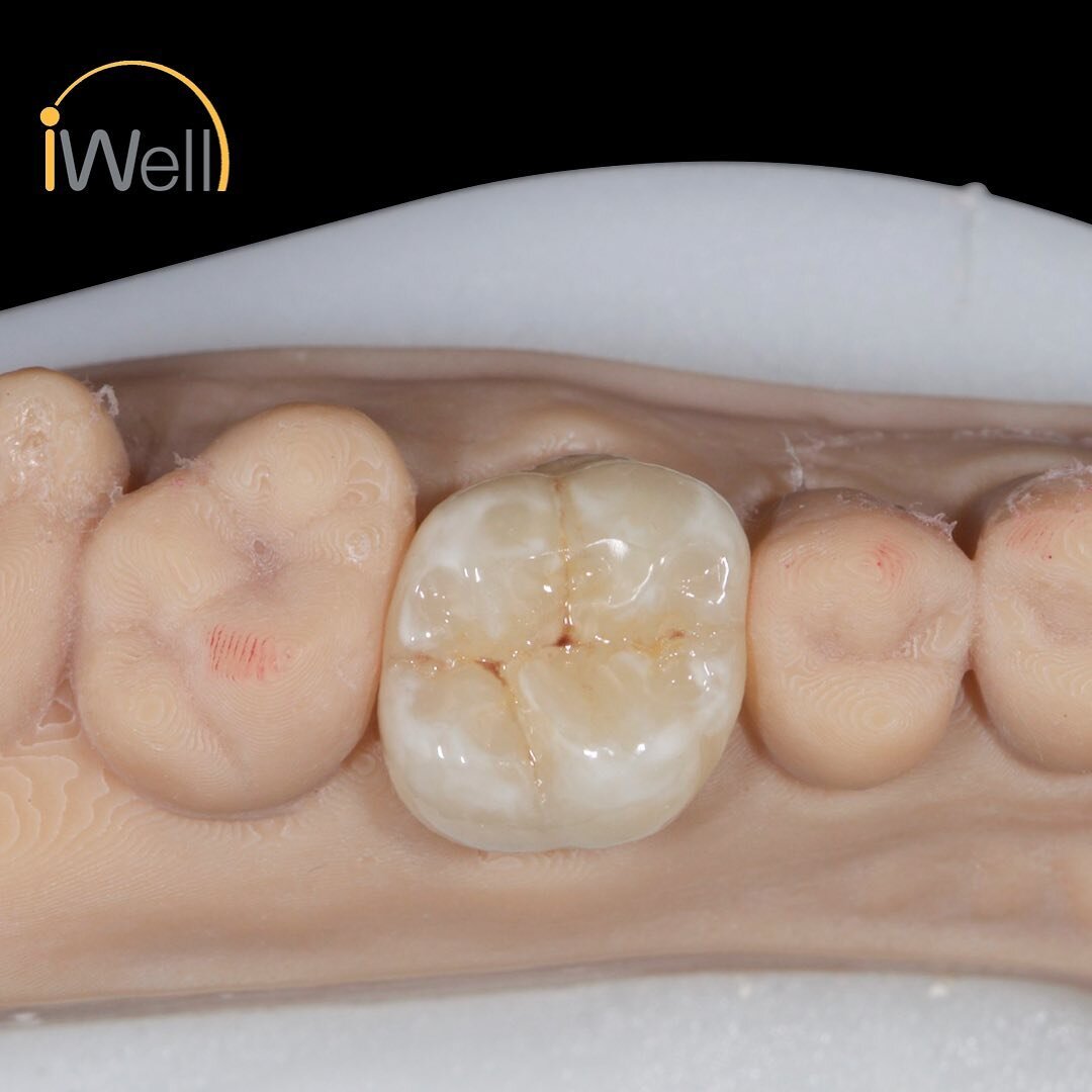 #emaxpress, #overlay, #allceramics, #cadcamdentistry, #hkdentallab, #3Dprinting, #iteroscanner, #formlabs, #exocad, #prosthodontics, #adhesivedentistry

Final restoration from scan of previous post.  Working and opposing models were 3D printed.  Over