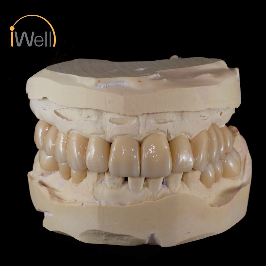 #fullcontourzirconia, #gradientshade, #zirconiacrowns, #cadcamdentistry, #fullmouthreconstruction, #allceramics

Natural results obtained with full contour zirconia crowns and bridges, which were milled using the latest gradient shaded zirconia milli