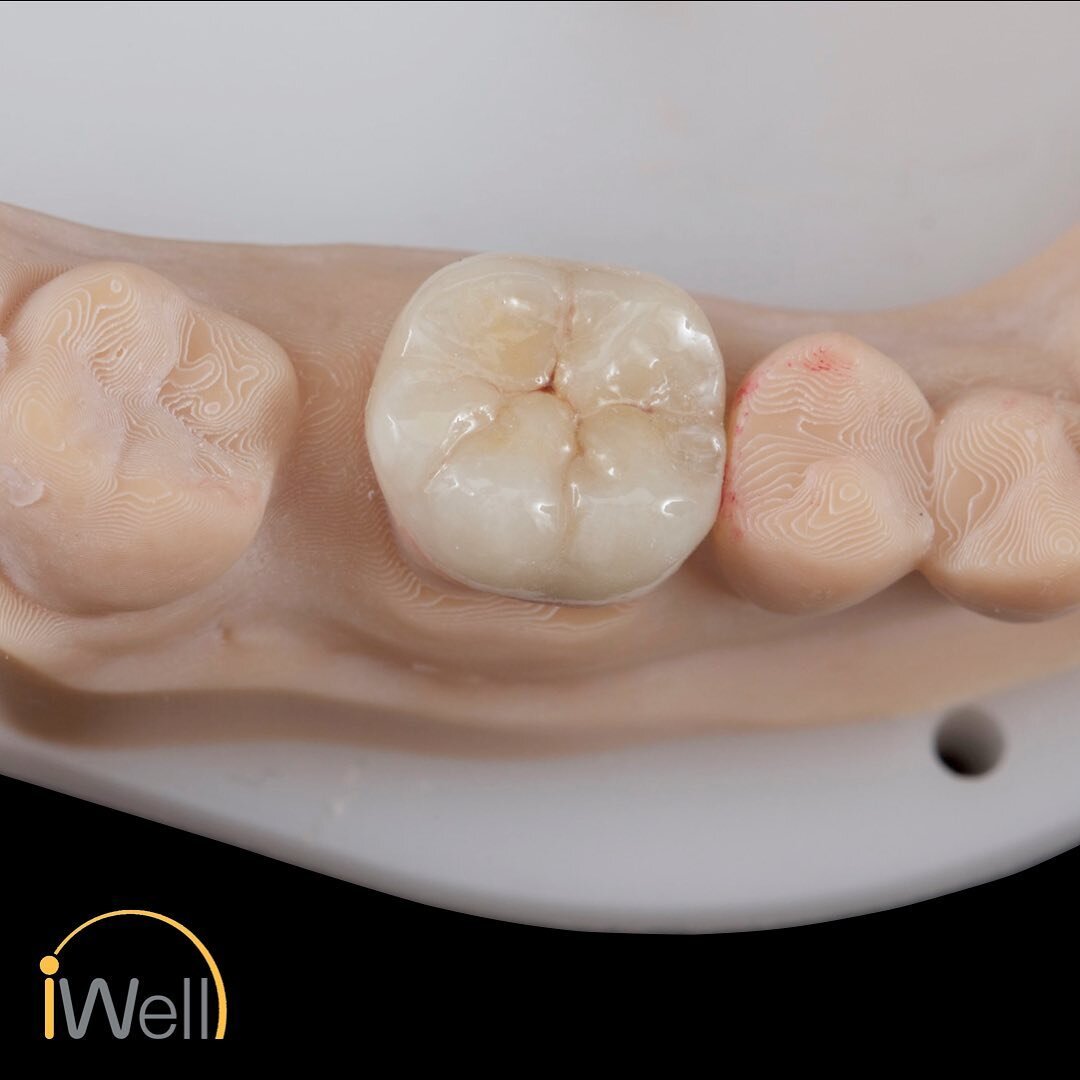 #overlay, #ivoclar, #emaxceram, #emaxpress, #allceramics, #adhesivedentistry, #dentalanatomy 

Overlay on #46. - Expertly Hand Waxed and made with Ivoclar Emax Press.  Cementation with heated composite for truly &ldquo;invisible&rdquo; margins.