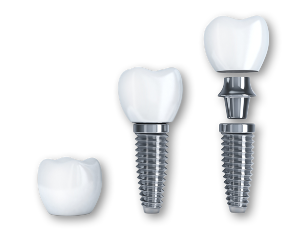 Dental implants