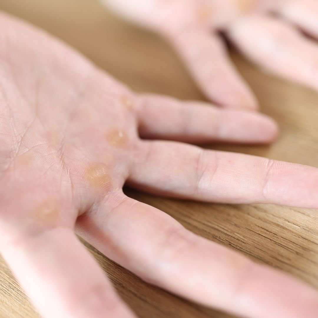 Why do we get Calluses on our hands and feet?