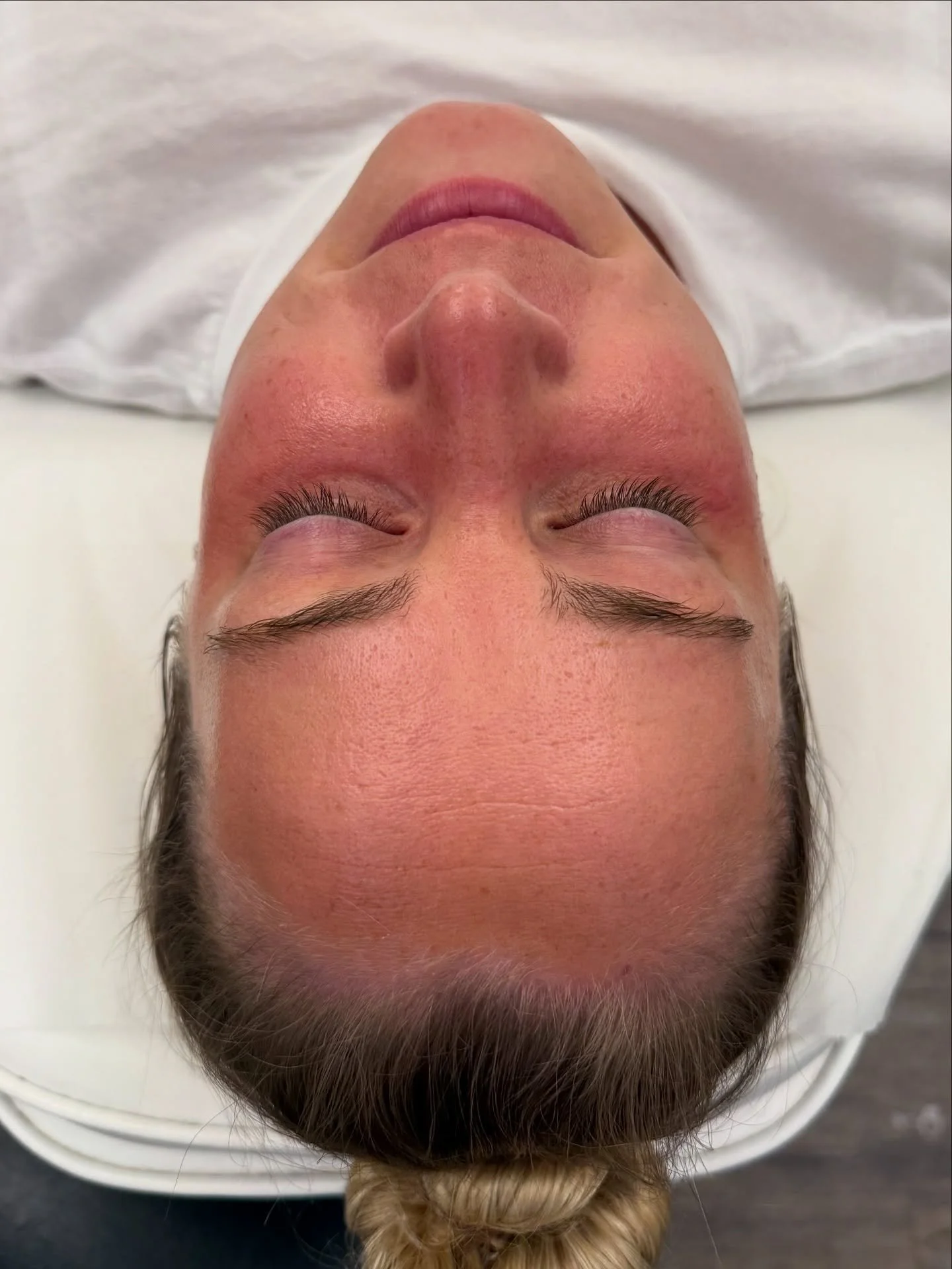 Facial refresh and milia removal for my beautiful SIL 🫶 check out the before and after! 🤯 

We took care of those pesky little white bumps (milia) because they were driving her absolutely nuts and we did a gentle enzyme facial and added dermaplanin