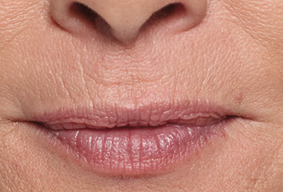 Lip Filler