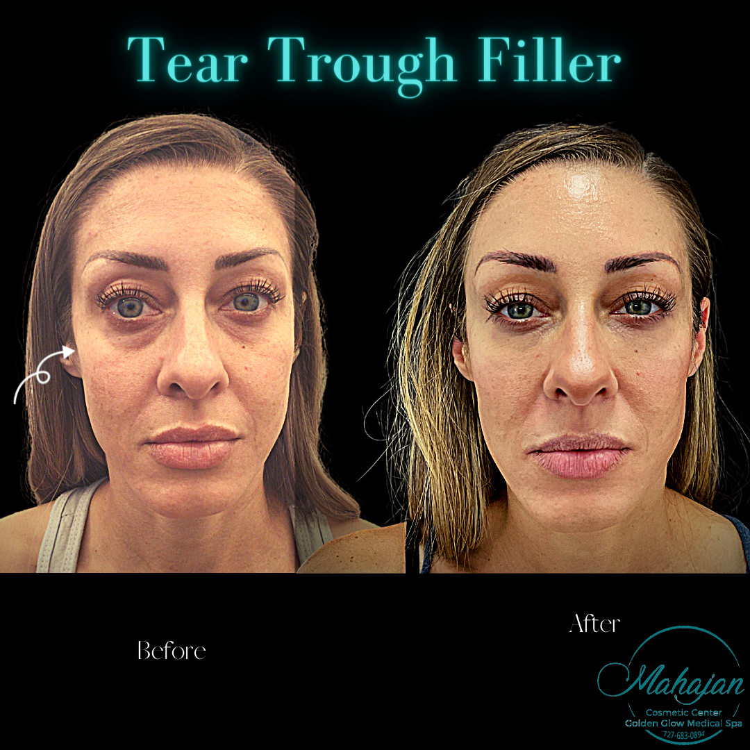 Under eye & cheek Filler