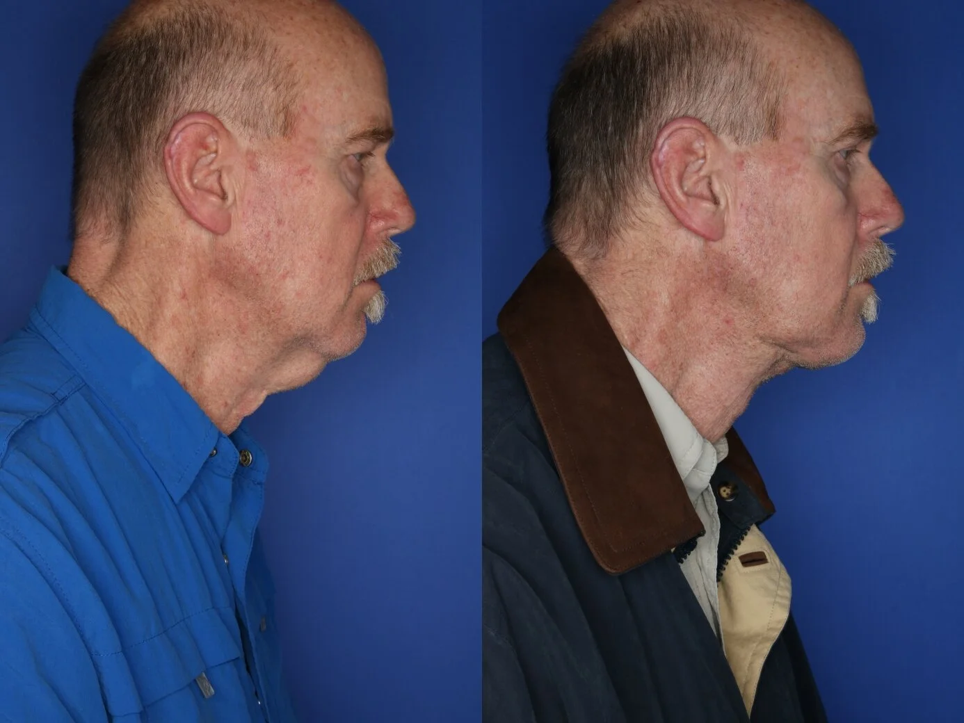 Liposuction 5ml & Thermitight-Under Chin -side