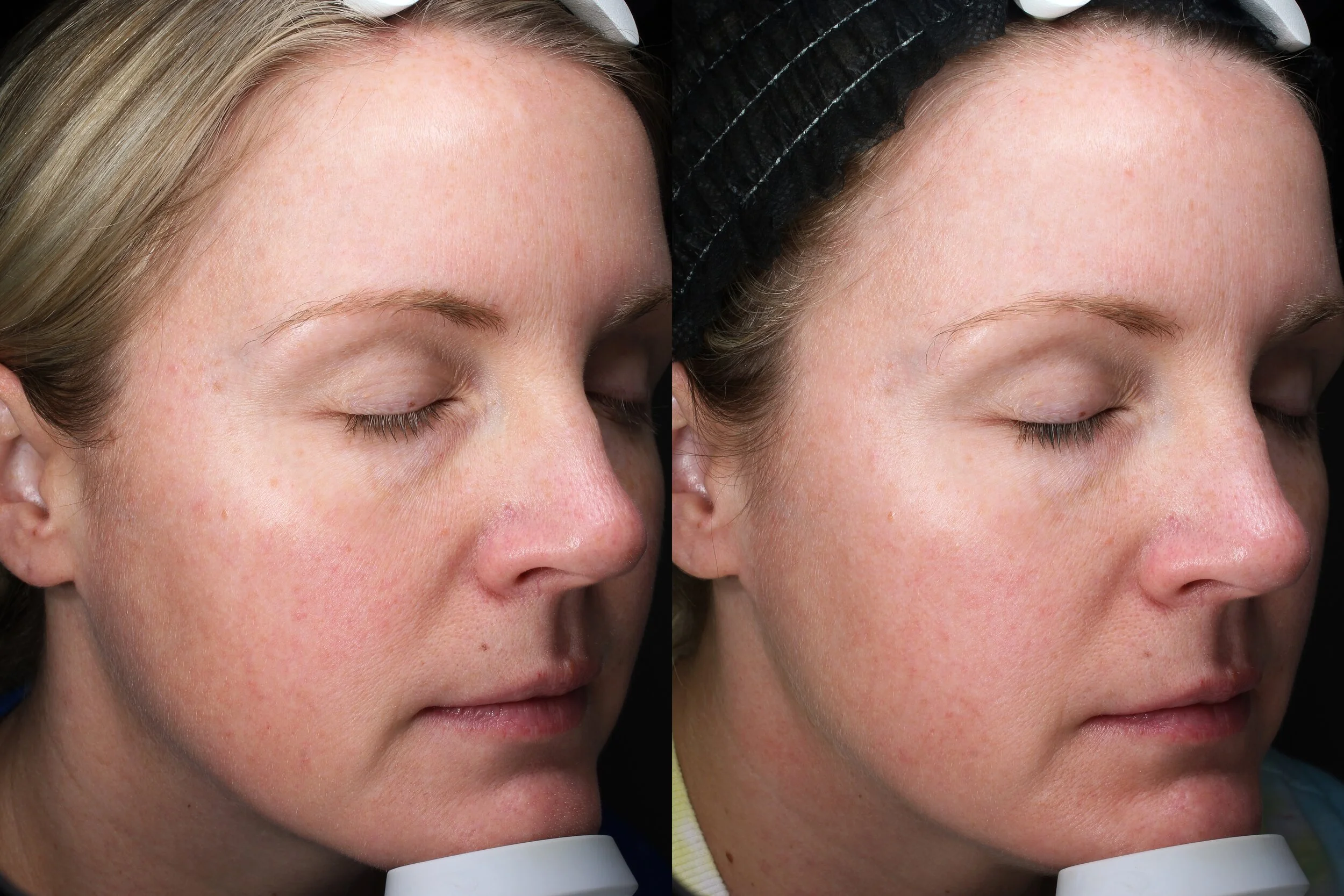 BBL/IPL — Golden Glow Medical Spa