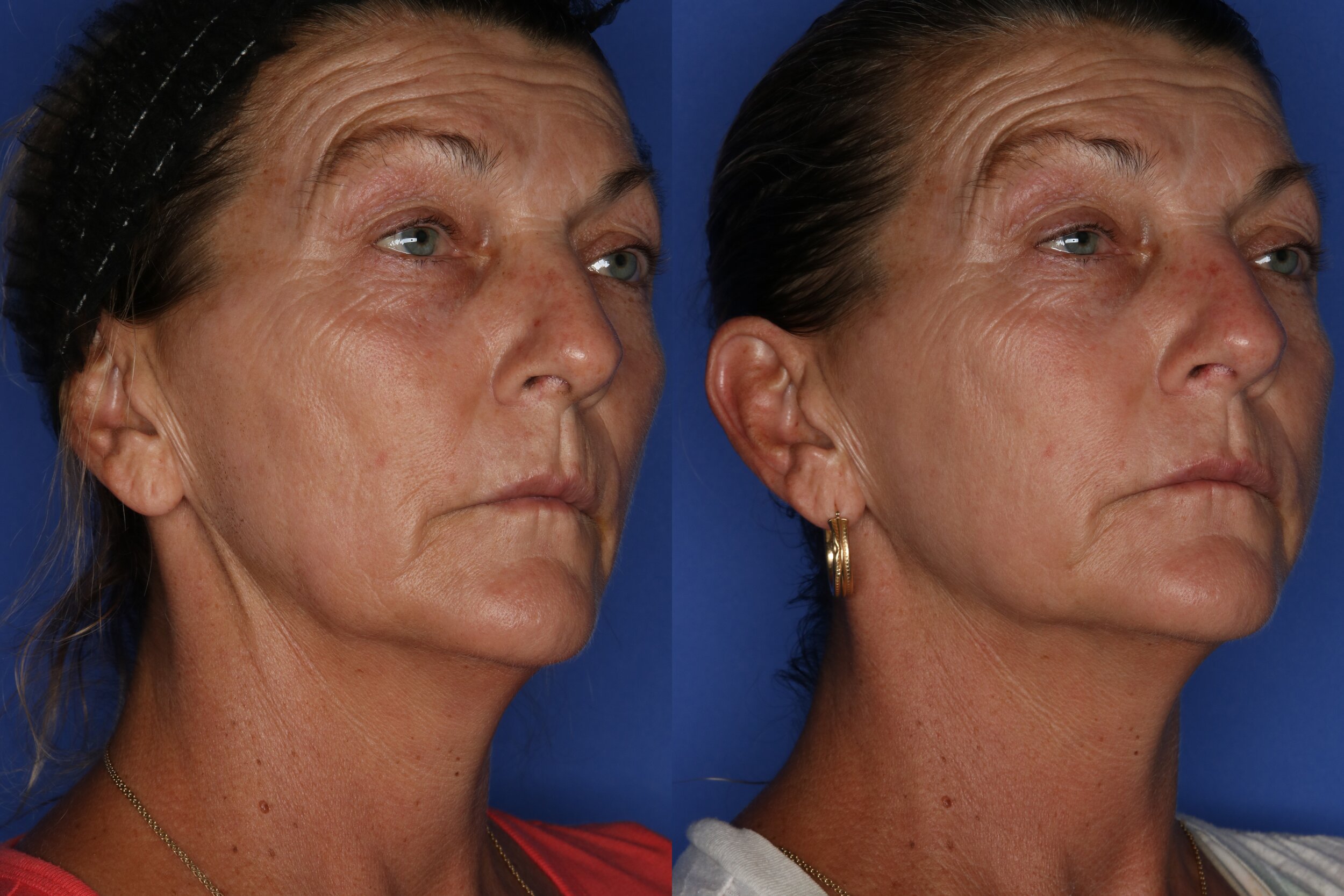 Thread Lift — Golden Glow Medical Spa