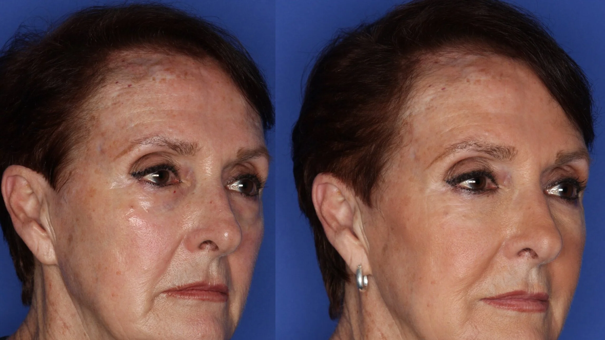 Under eye and cheek filler
