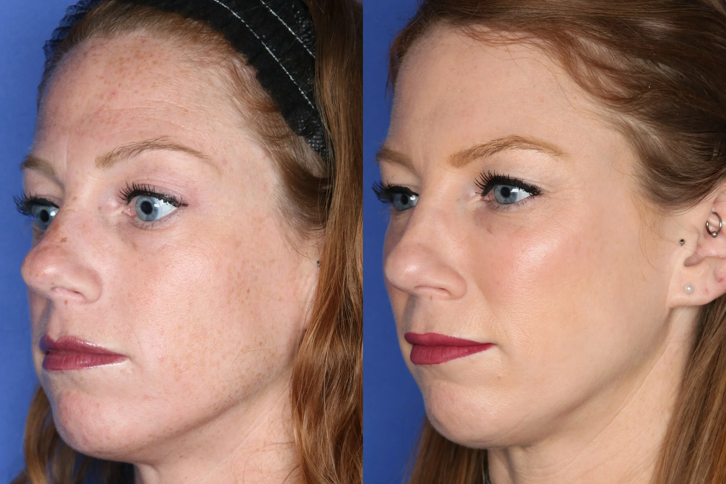 Cheek filler- Juvederm Voluma