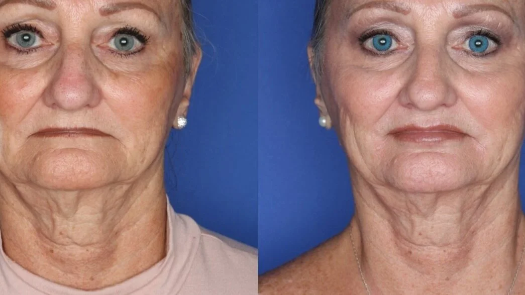 lip volume & Marionette