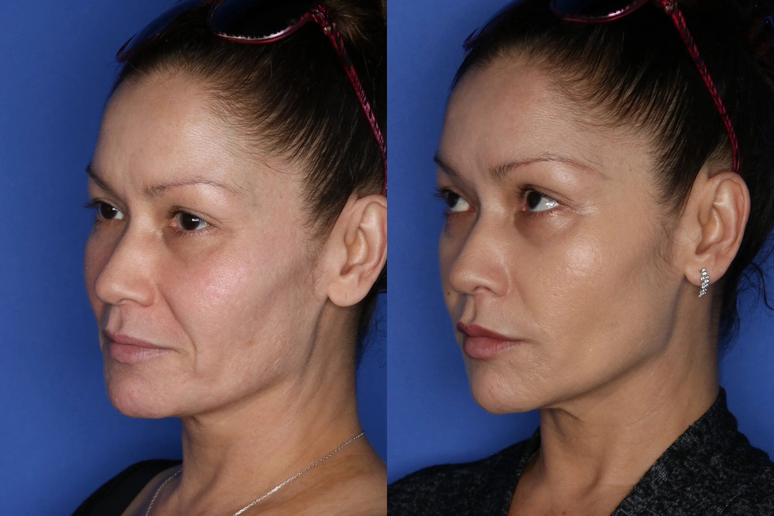 Радиесс Векторный Лифтинг Цена И Отзывы