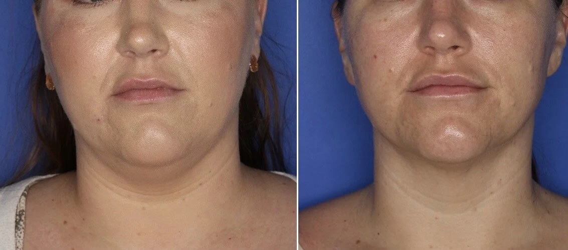 Kybella-under chin