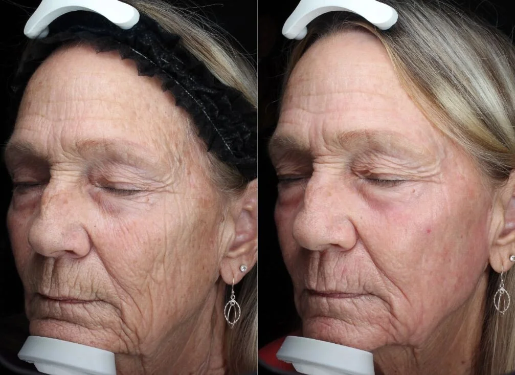 Deep skin Resurfacing( Fractional Co2 laser)at Golden Glow Medical Spa