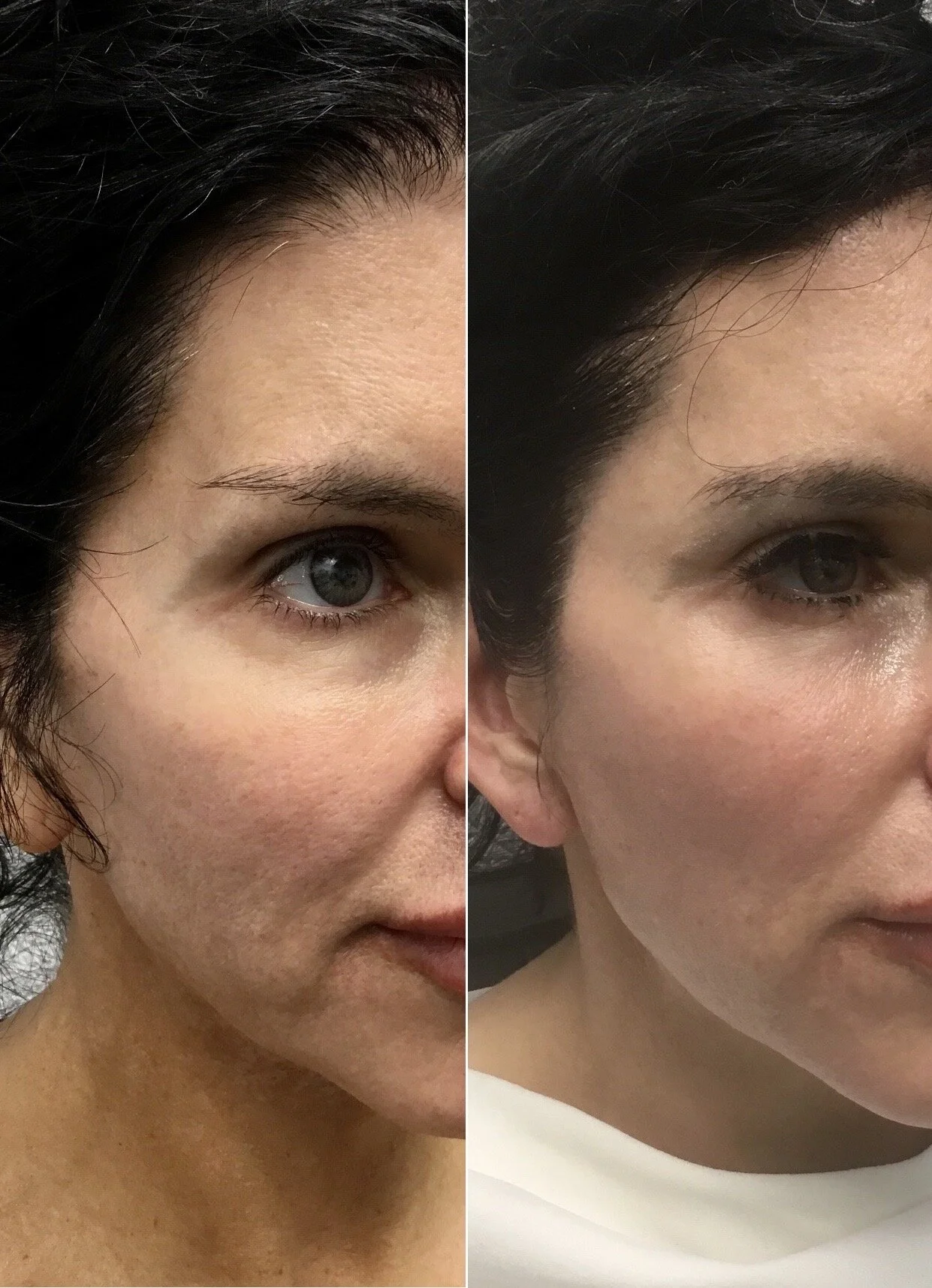 Temple Filler & lower face Thread lift