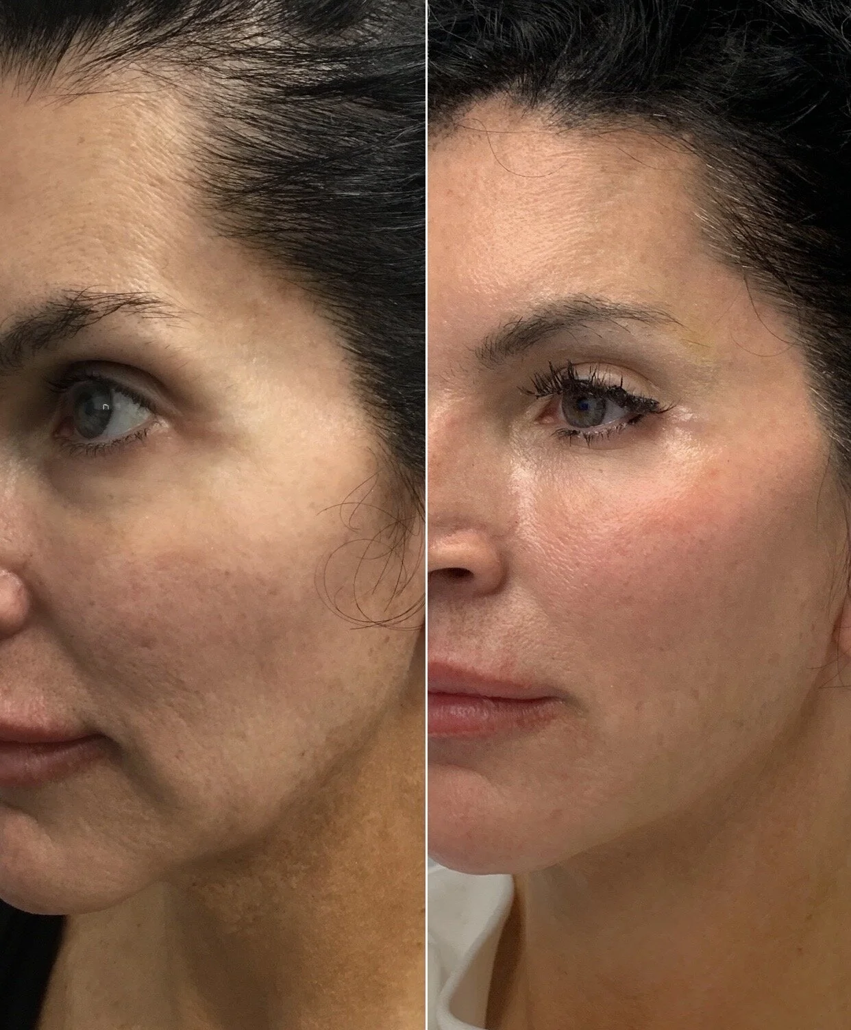 Temple Filler & Lower face Thread lift