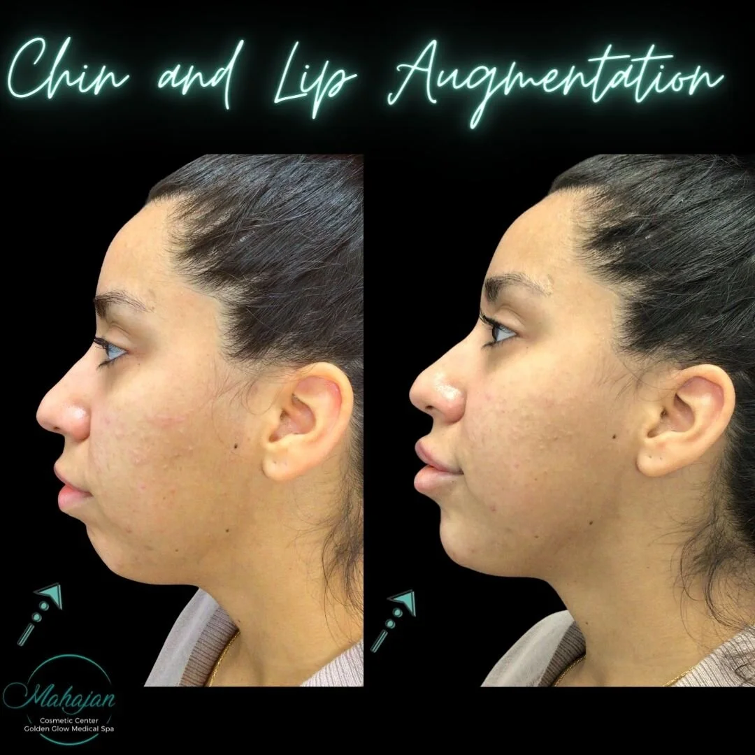 Chin and Lip Augmentation.jpg