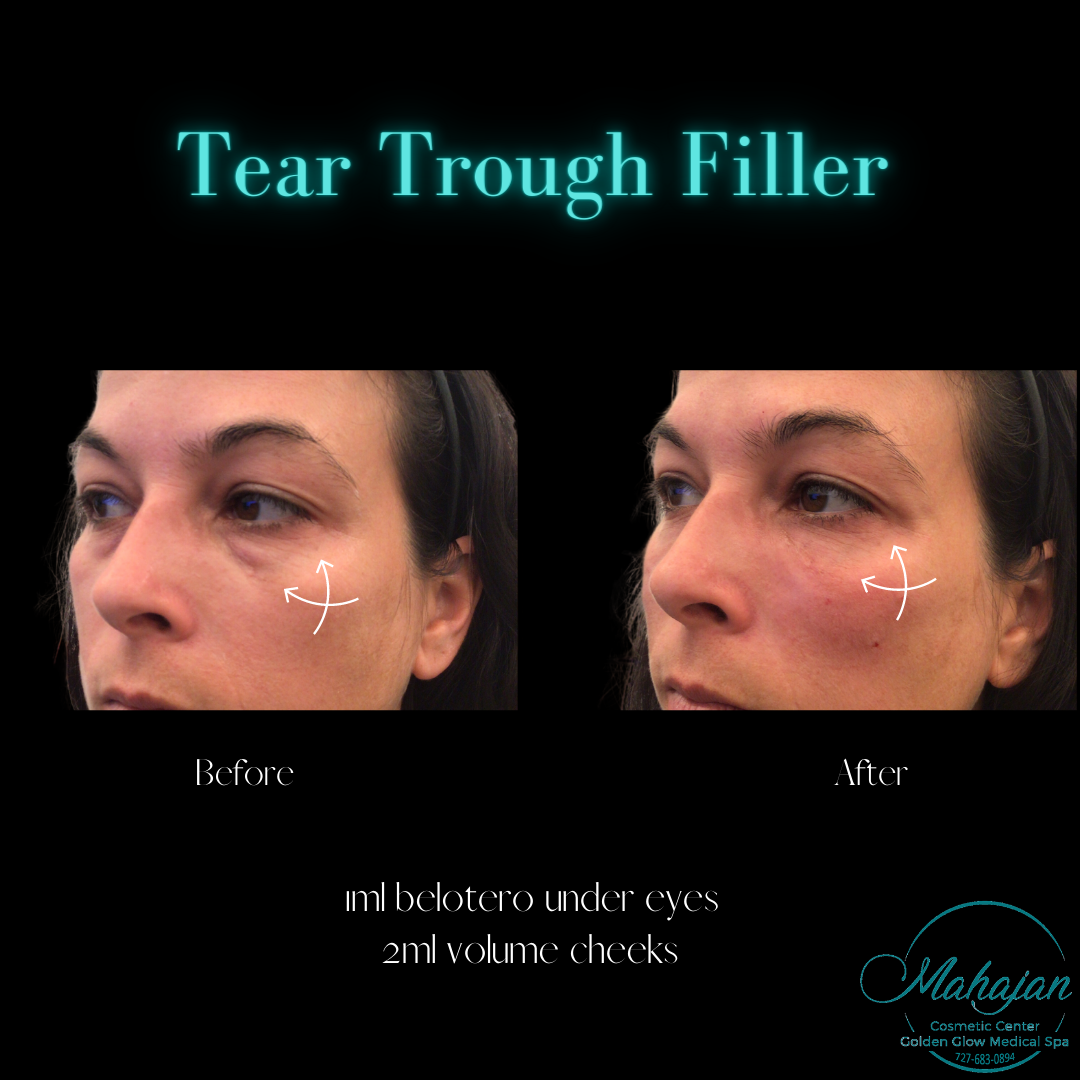 under eye & cheek filler