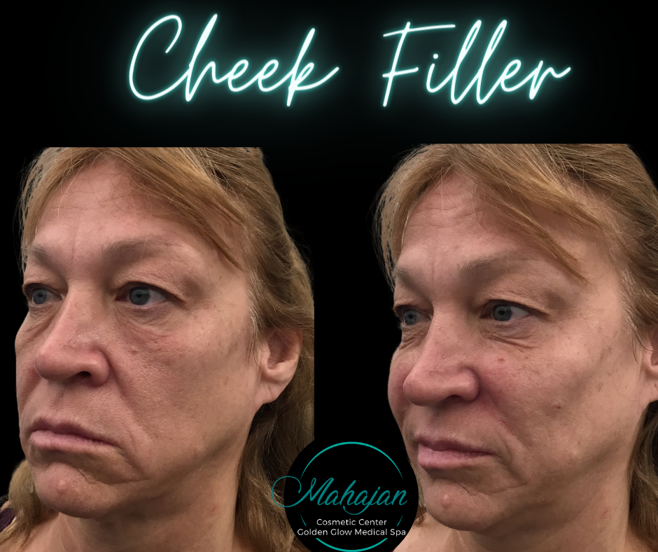 Dermal Fillers.png