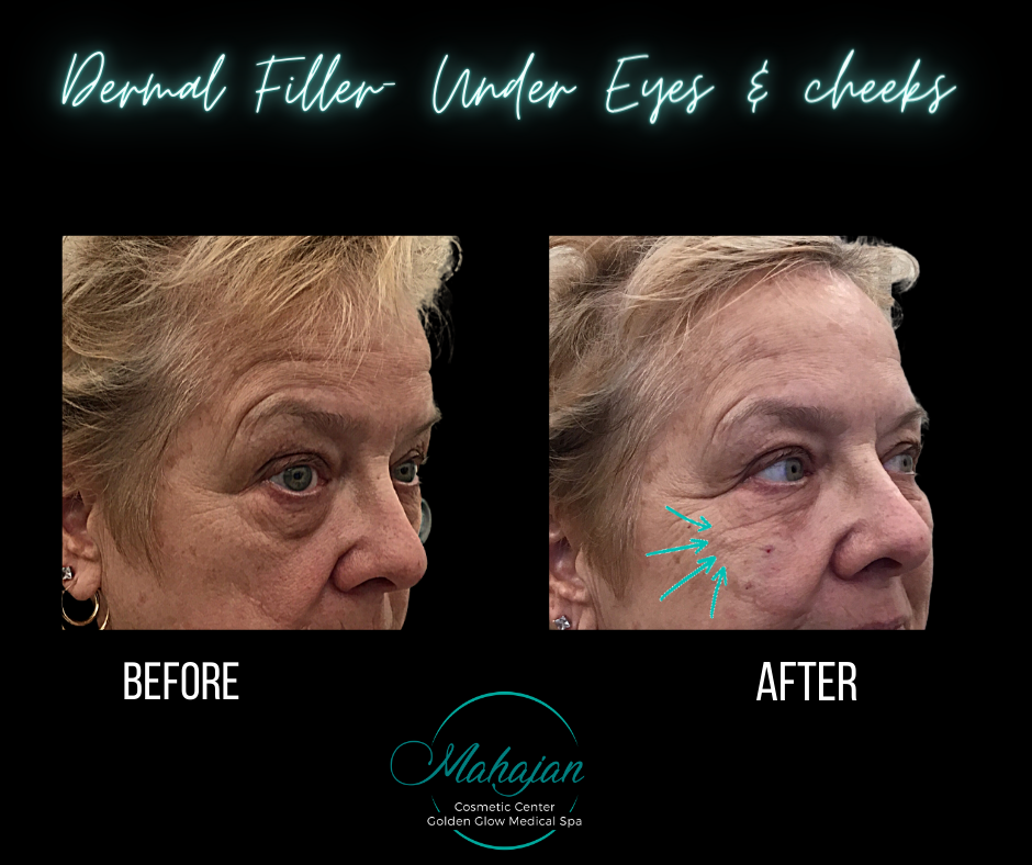 Under eye and cheek filler