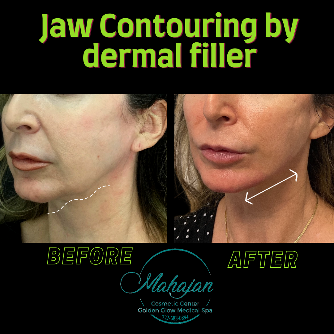 3 ml Juvederm Voluma to chin & Jaw