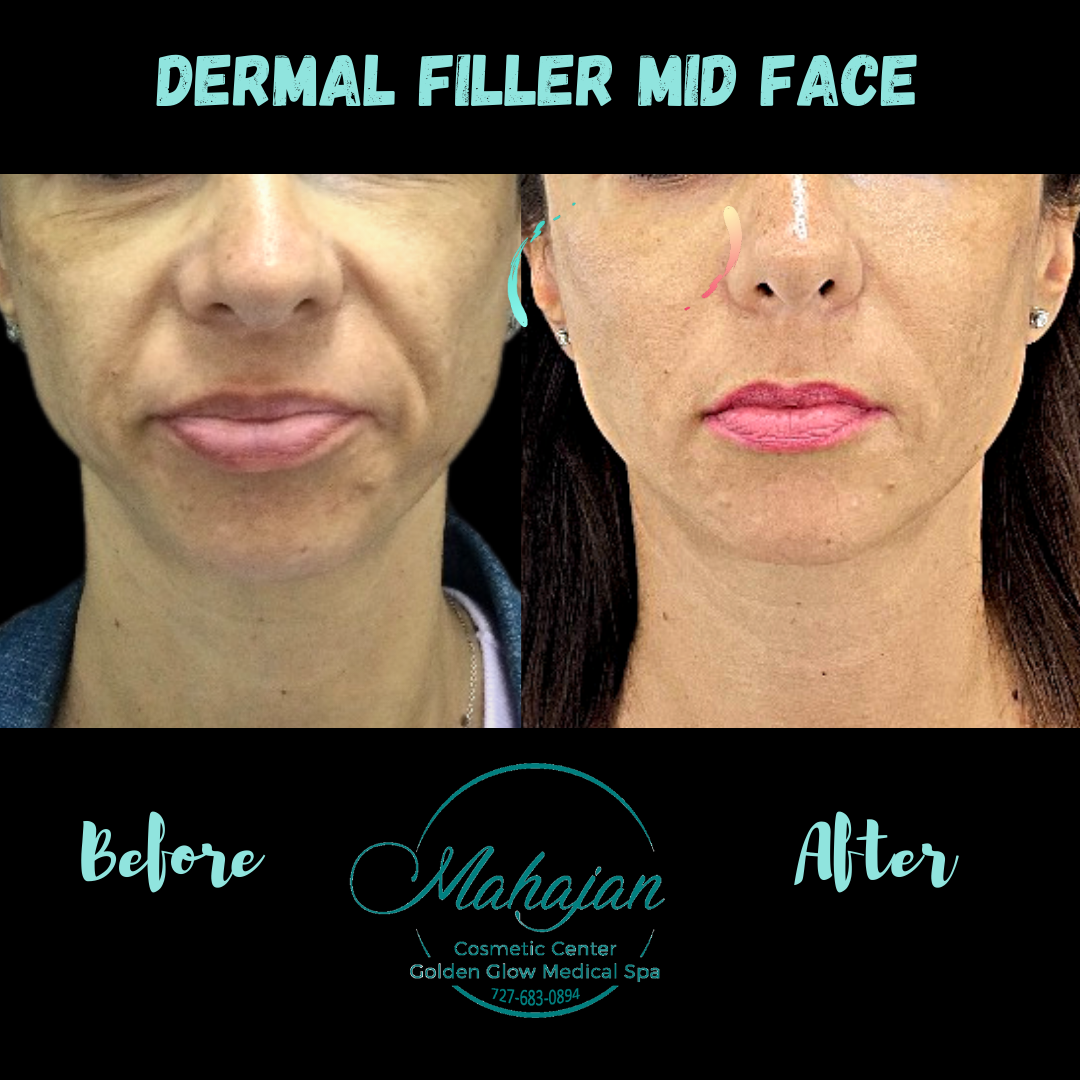 Copy of Liquid face lift.png