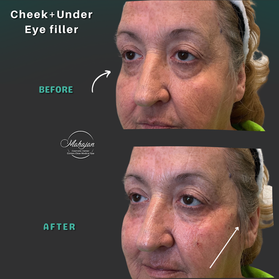Mid face dermal fillers