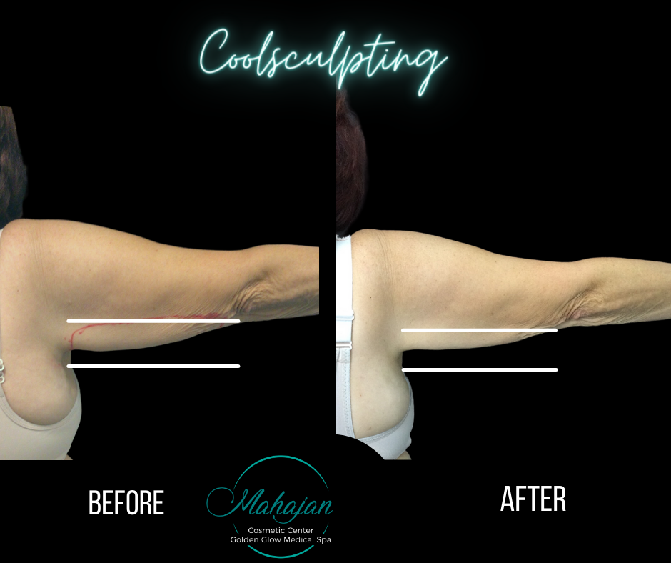 Coolsculpting after 1 treatment